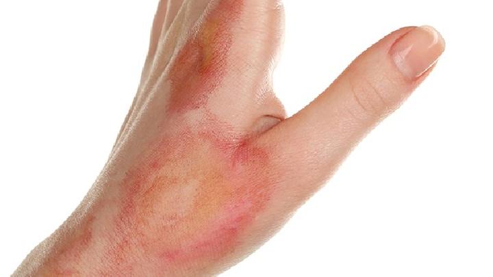 烫伤处的肌肤如何恢复正常？