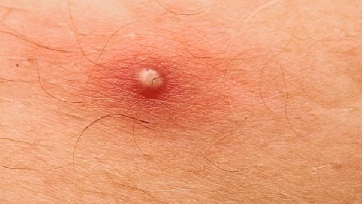 分享下发疱性甲虫皮炎怎么治疗