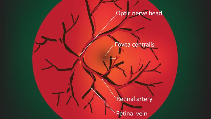 右眼视网膜中央静脉阻塞怎么办
