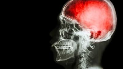 导致脑萎缩发病有哪些因素呢?