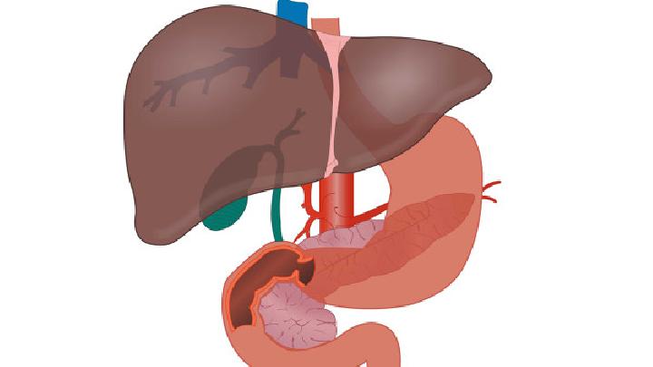 癌性肝腹水依据症状可分为5型