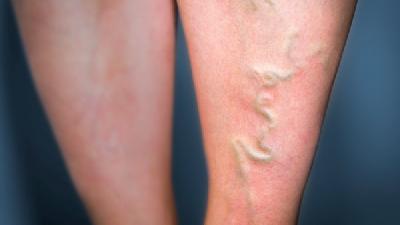 浅谈静脉曲张如何进行治疗