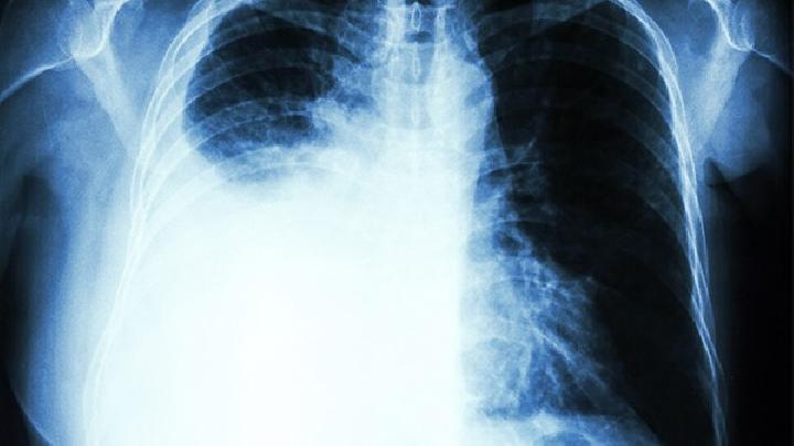 肺癌——及时的控制病情