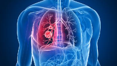 临床上的肺癌症状都有哪些
