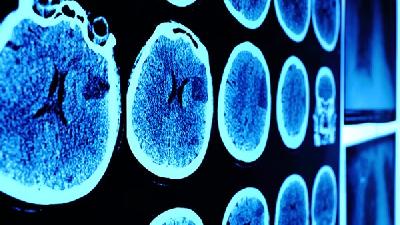 脑癌的诊断有哪些项目?