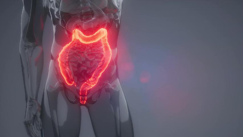教你如何治療晚期大腸癌