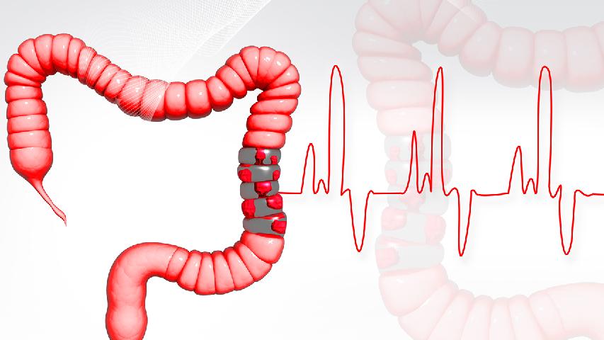 結(jié)腸癌是由什么原因引起的？