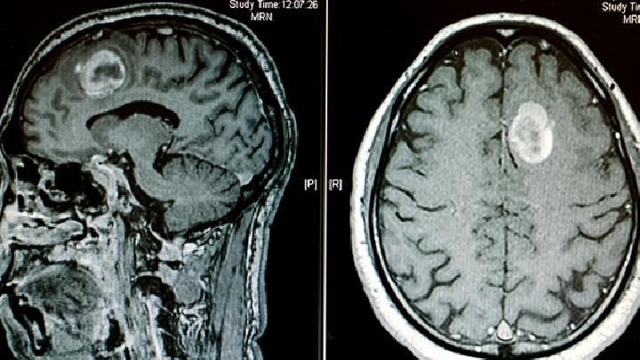 脑癌有哪些症状呢？
