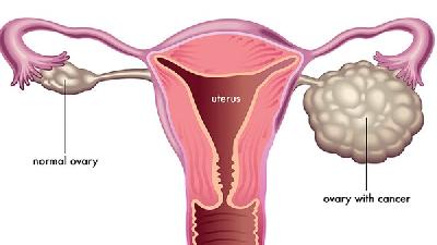 卵巢癌的诊断方法有哪些？