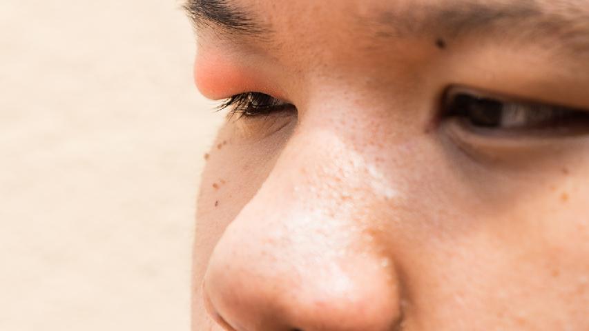 中医治疗玻璃体混浊的方法