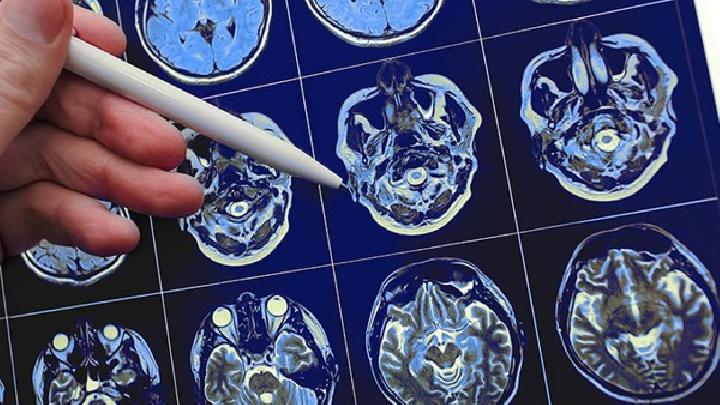 脑癌的症状具体是什么