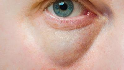 引起干眼症的病因有哪些