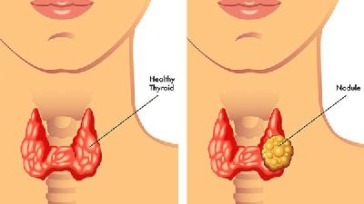 引发慢性咽炎的病因是什么?