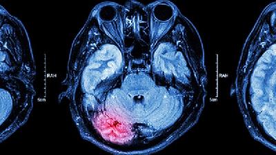 什么是最科学的脑萎缩诊断？