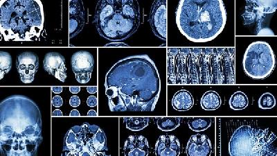 早期脑萎缩有什么症状呢?