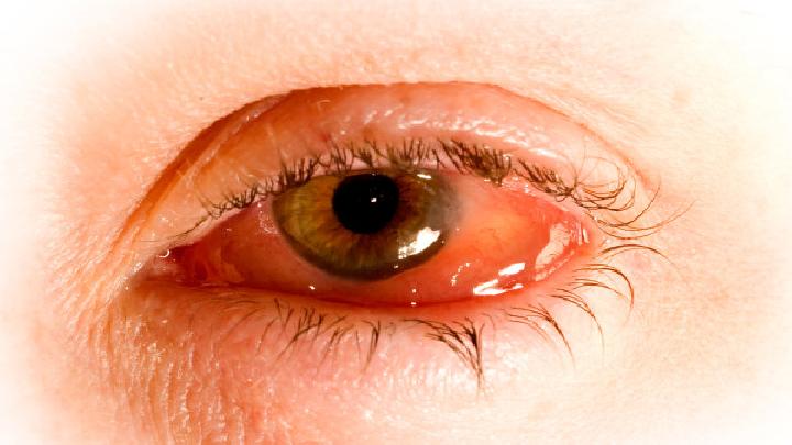 慢性单纯性青光眼有哪些临床症状