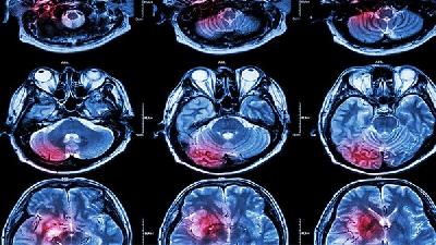 晚期脑萎缩的症状表现是什么