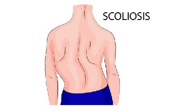 脊柱侧弯的症状有哪些?