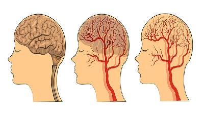 脑萎缩发病的是有哪些因素引起的呢?