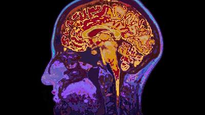 老年性脑萎缩的病因是什么呢?