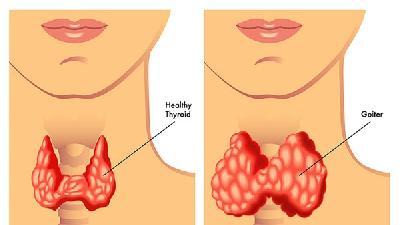 咽炎的外界因素有哪些呢?