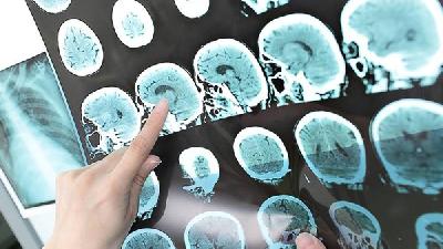 專家揭示老年性腦萎縮的信號