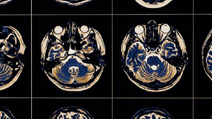 专家详解头晕型脑萎缩的临床症状