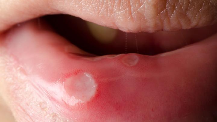 口腔溃疡的早期症状是什么