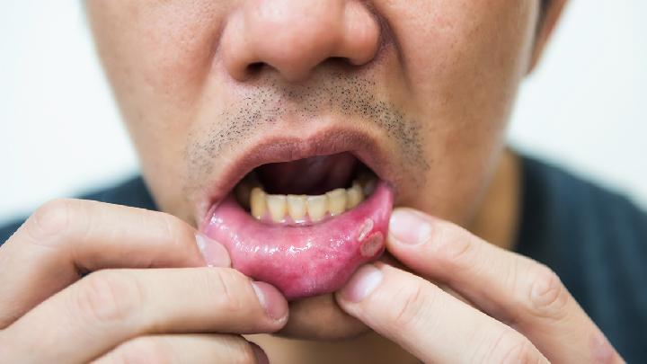 口腔溃疡的早期症状有哪些