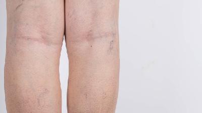 是什么原因才造成静脉曲张的发生