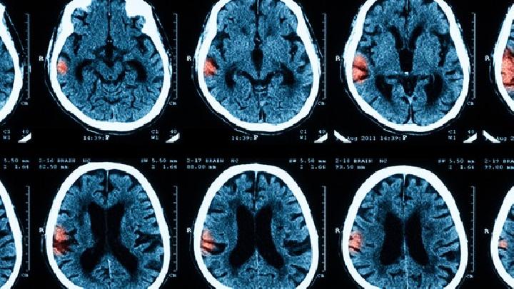 脑萎缩的治疗需要注意6个方面