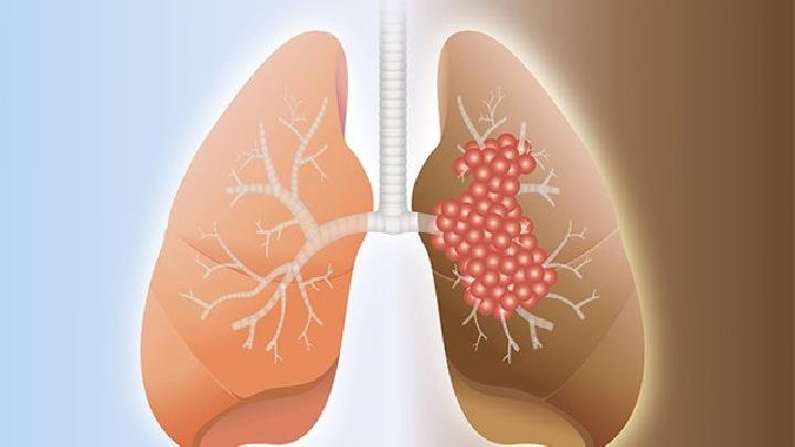 早期肺癌手术能不能治？