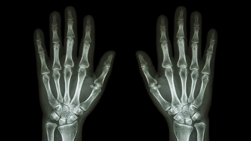 类风湿性关节炎自我护理的一些方法