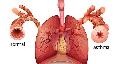 哮喘发作的特点有哪些