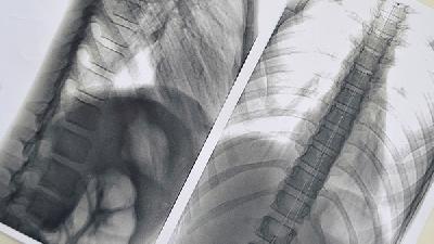 了解肺炎的成因主要是什么?