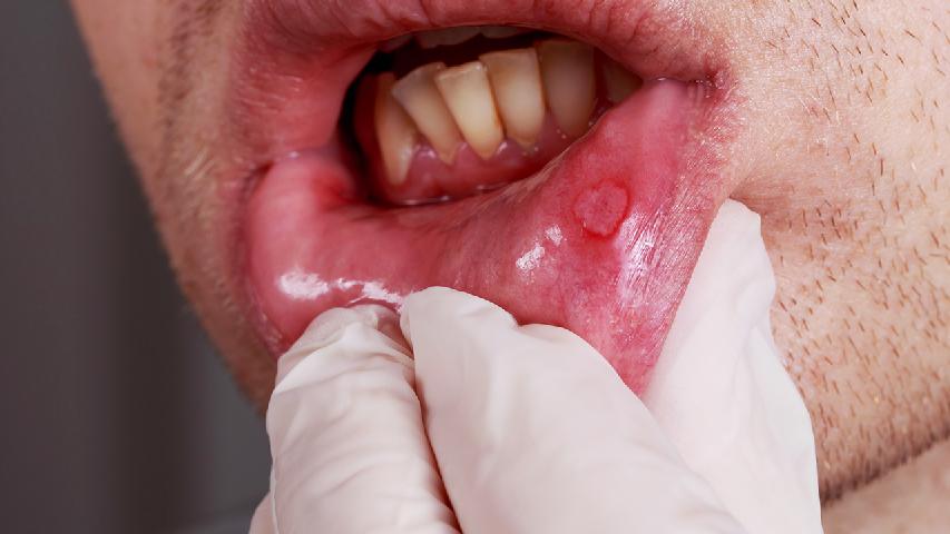 口腔溃疡的症状都有哪些呢?