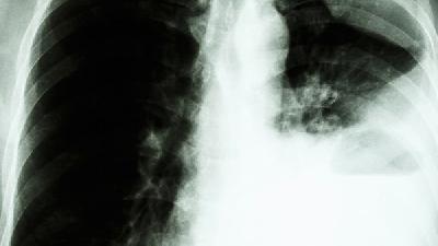 早期肺癌治疗是怎样的