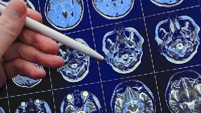教教你如何區(qū)別腦萎縮的早期癥狀