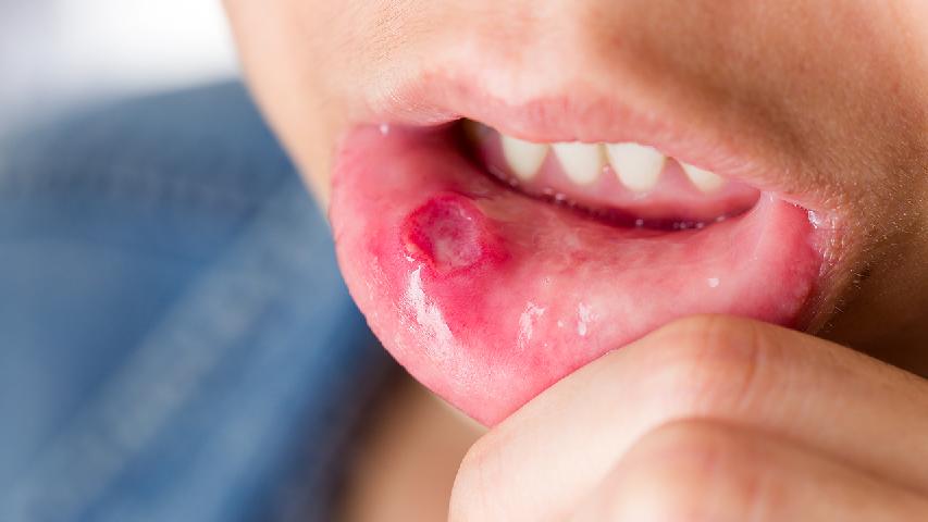 不同时期的口腔溃疡的类型有哪些症状？