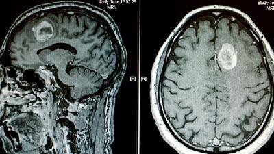 脑萎缩的诊断依据是什么吗?