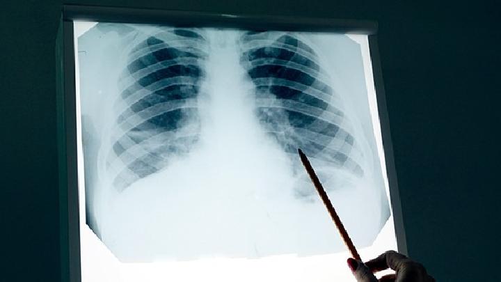 警惕：肺癌形成的主要原因
