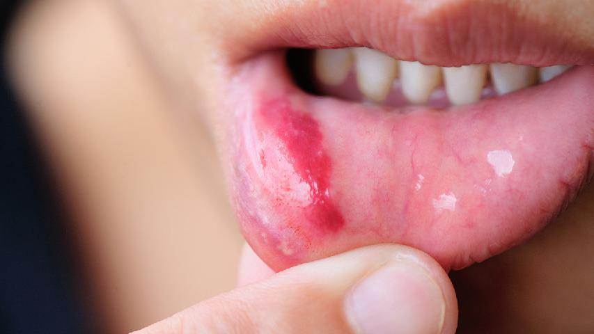 口腔溃疡有哪些症状的呢?