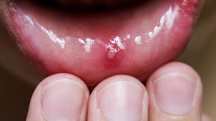 口腔溃疡的症状都有什么呢?