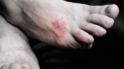 头部牛皮癣要及早治疗