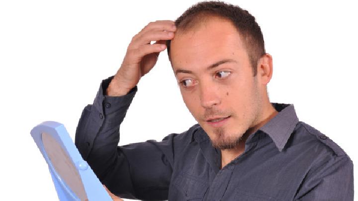 脂溢性脱发有哪些症状？