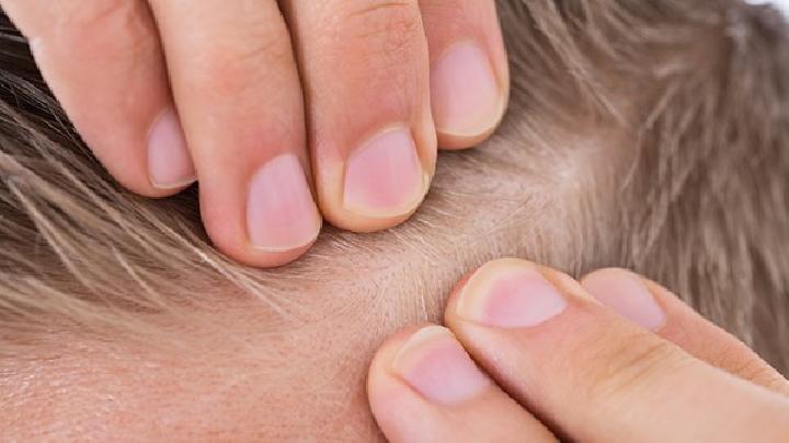 脂溢性脱发有什么症状呢？该怎么治疗呢？
