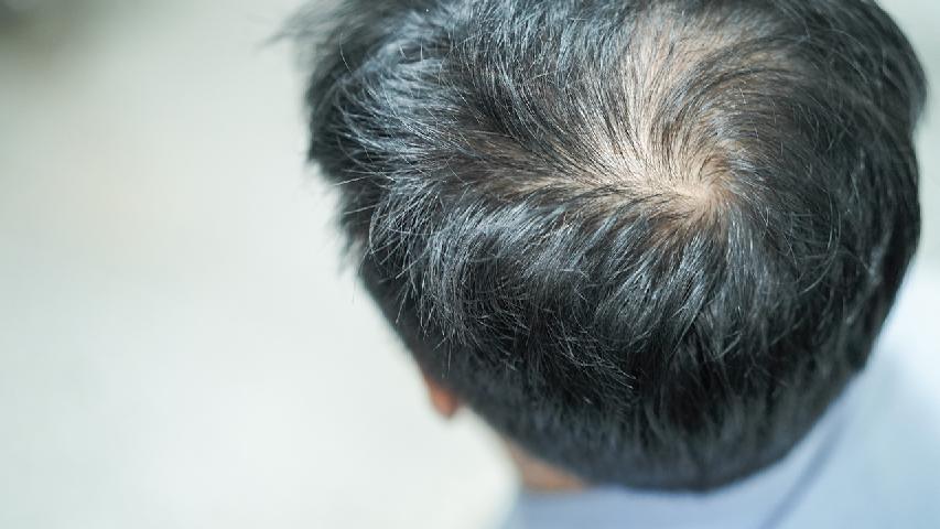 不同類型的脫發(fā)該如何治療