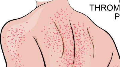 急性荨麻疹患者的症状特点您知道吗?