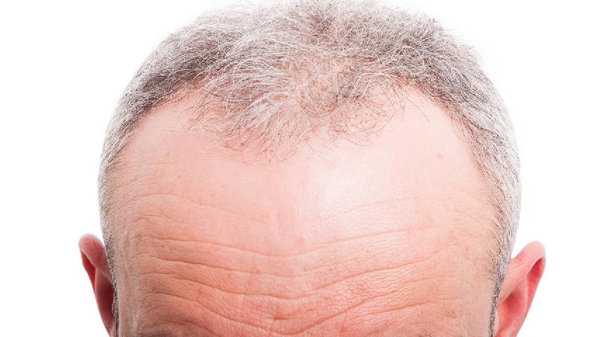 中年男人如何防治脫發(fā)?