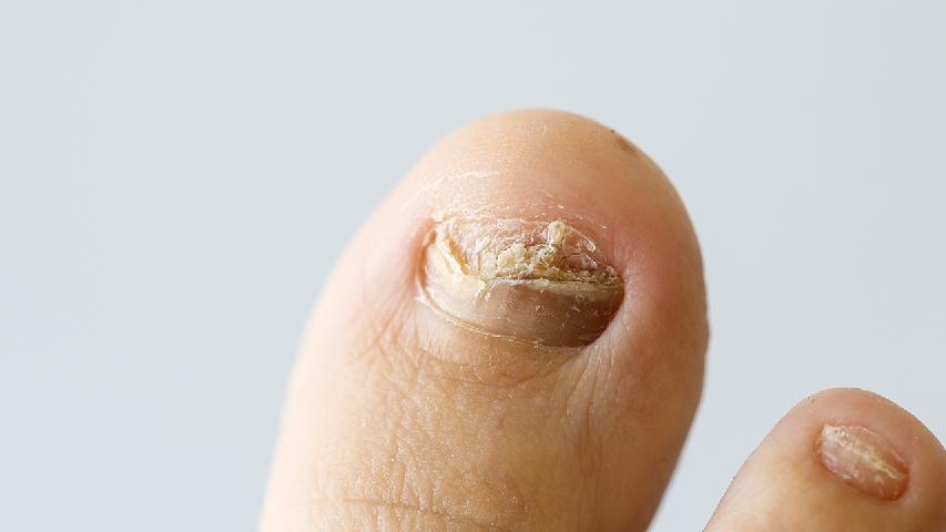 专家为您解答灰指甲有哪些症状